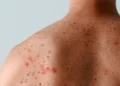 Minas Gerais confirma casos de mpox em 2026: entenda a doença, sintomas e como se prevenir