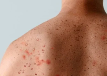 Minas Gerais confirma casos de mpox em 2026: entenda a doença, sintomas e como se prevenir