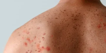 Minas Gerais confirma casos de mpox em 2026: entenda a doença, sintomas e como se prevenir