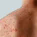 Minas Gerais confirma casos de mpox em 2026: entenda a doença, sintomas e como se prevenir